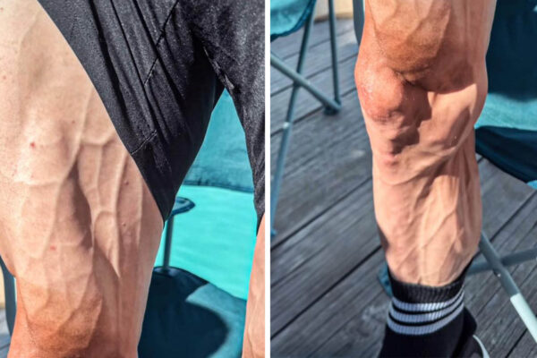 Takto vyzerajú nohy cyklistu po dvoch týždňoch na Tour de France. Čím je to spôsobené?